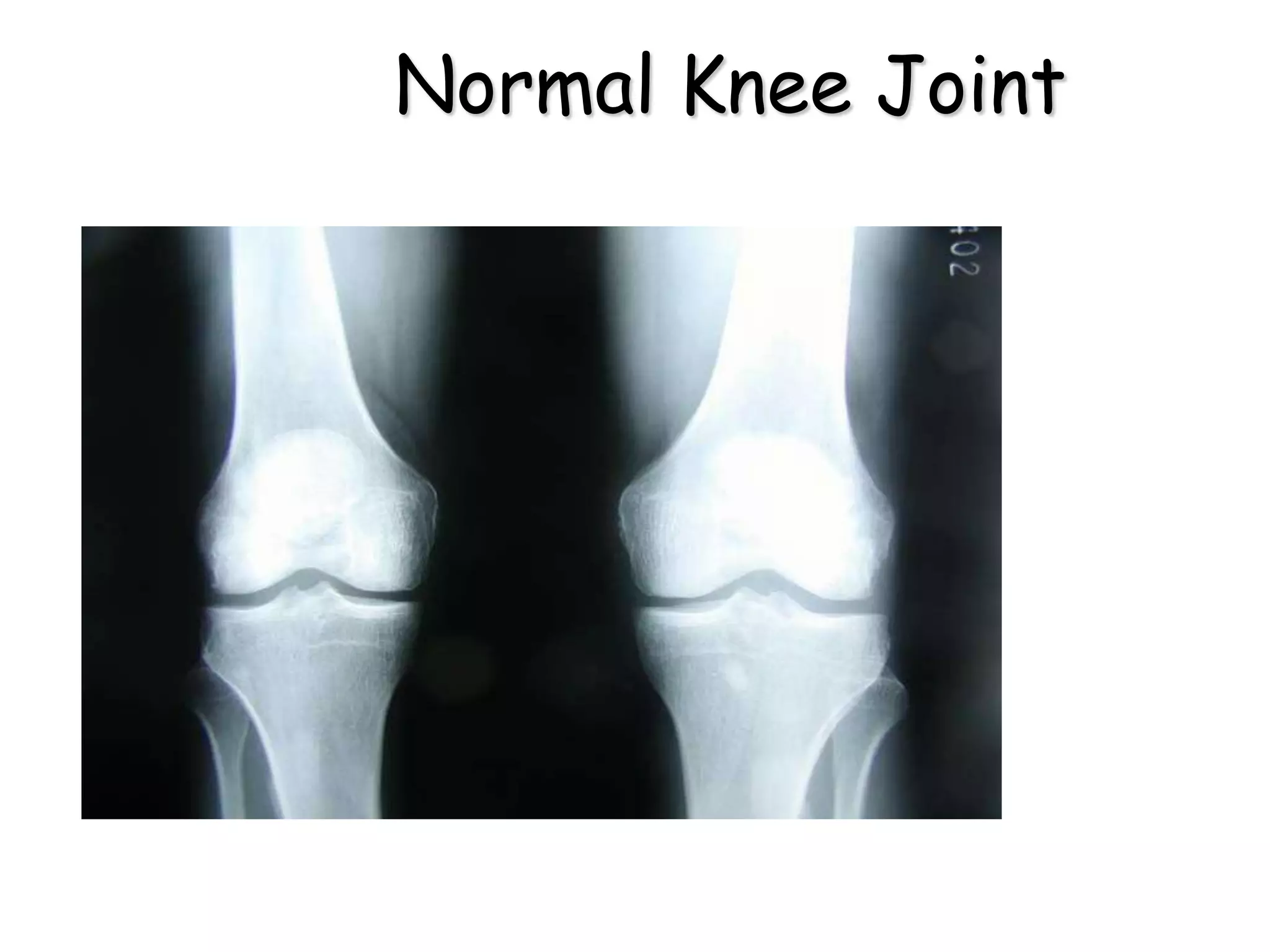 Normal Knee Joint
 