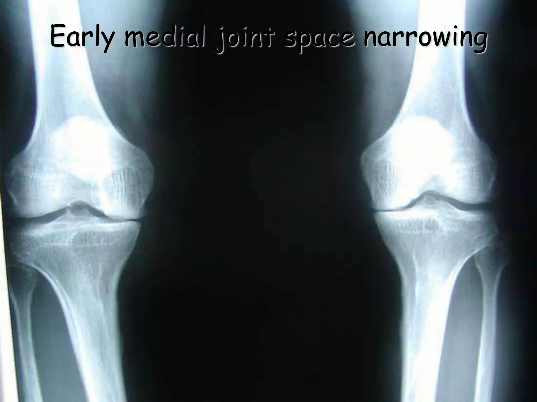 Early medial joint space narrowing
 