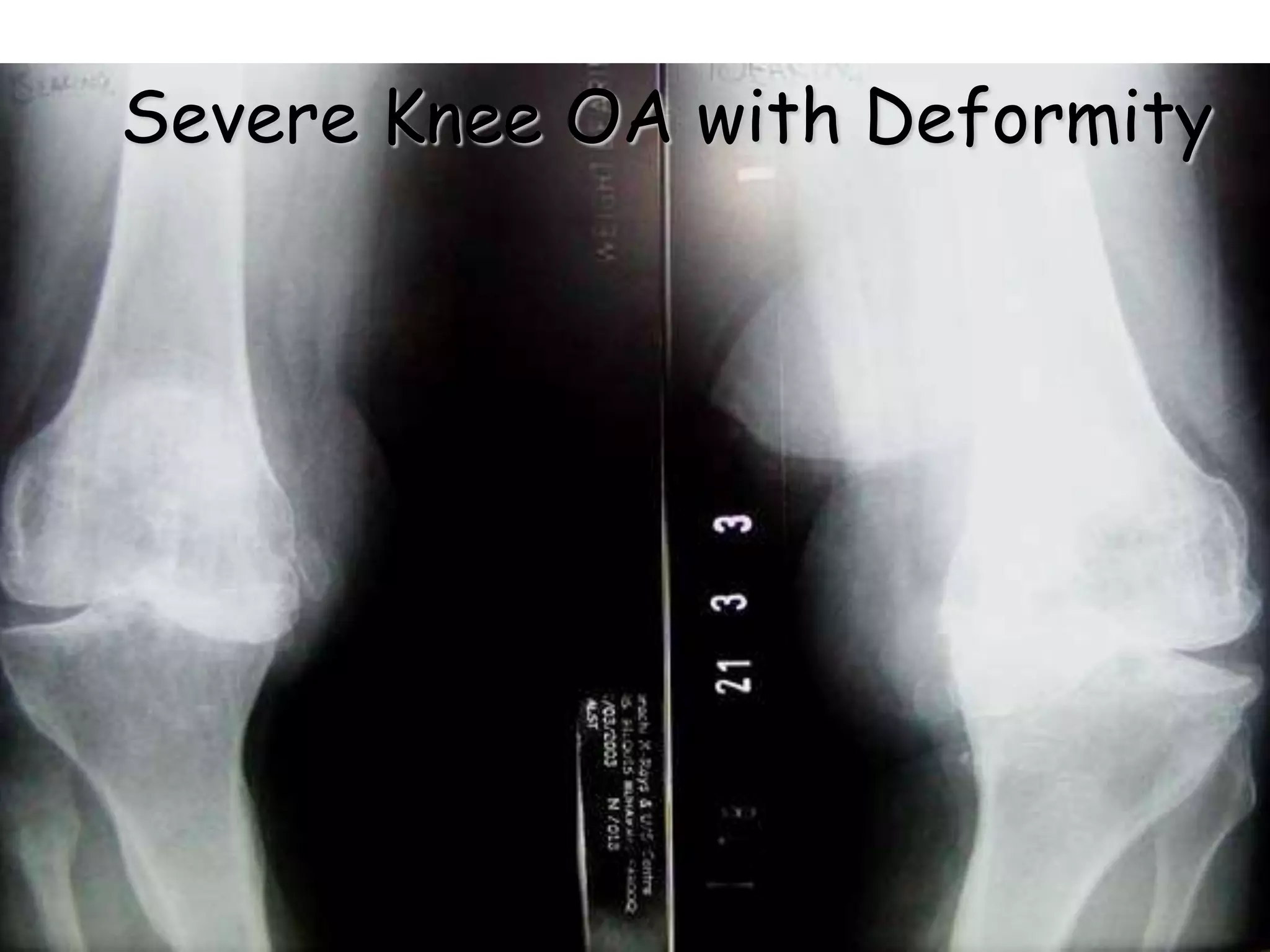 Severe Knee OA with Deformity
 