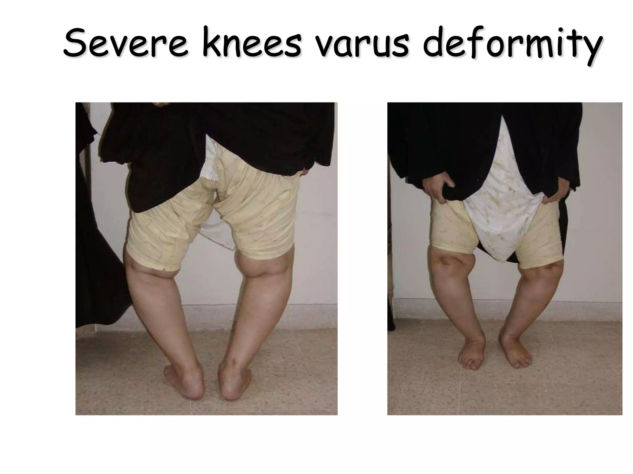 Severe knees varus deformity
 