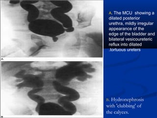 A. The MCU showing a
dilated posterior
urethra, mildly irregular
appearance of the
edge of the bladder and
bilateral vesicoureteric
reflux into dilated
tortuous ureters.
B. Hydronephrosis
with 'clubbing' of
the calyces.
 