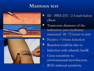 Mantoux testMantoux test
 ID - PPD-2TU- 2-4 inch belowID - PPD-2TU- 2-4 inch below
elbowelbow
 Transverse diameter of theTransverse diameter of the
induration (not erythema)induration (not erythema)
measured- 48 -72 hours in mmmeasured- 48 -72 hours in mm
 Positive >10mm-InfectionPositive >10mm-Infection
 Reaction could be due to
1. Infection with tubercle bacilli
2. Cross sensitivity to
environmental mycobacteria
3. BCG-induced sensitivity
 