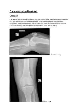 Commonlymissed fractures
Knee pain
A 36 yearold lady presentswithleftknee painafterslippingonice.She now hassevere knee pain
withmildswelling,andisunable toweightbear.Triage nurseshave givenhercodeineand
paracetamol,butexaminationisstill difficultdue topain.She isverytender alongthe jointline
particularlymedially,andcannotflex orextendherknee.She issentforanXray:
Lateral knee X-ray
AP knee X-ray
 