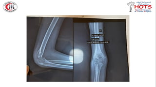 Commonly missed injures in Orthopedic.pptx