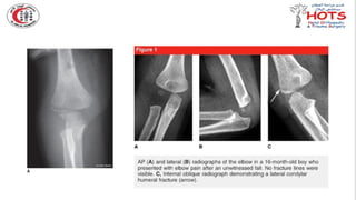 Commonly missed injures in Orthopedic.pptx