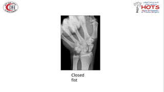 Commonly missed injures in Orthopedic.pptx