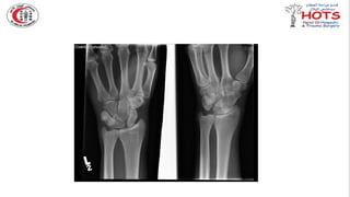Commonly missed injures in Orthopedic.pptx
