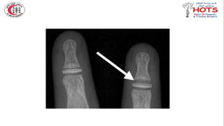 Commonly missed injures in Orthopedic.pptx