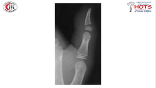 Commonly missed injures in Orthopedic.pptx