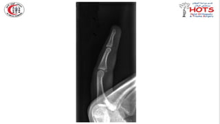Commonly missed injures in Orthopedic.pptx