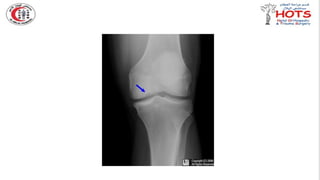 Commonly missed injures in Orthopedic.pptx
