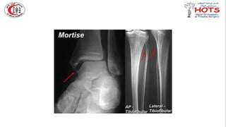 Commonly missed injures in Orthopedic.pptx