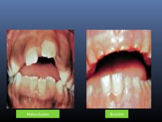 Malocclusion Bruxism
 