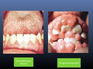 Periondotal gum
disease Gingival overgrowth
 