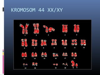 KROMOSOM 44 XX/XY
 