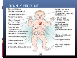 DOWN SYNDROME
 