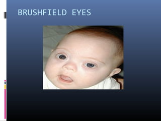 BRUSHFIELD EYES
 