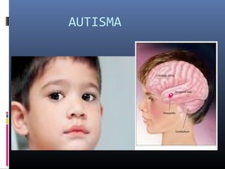 AUTISMA
 