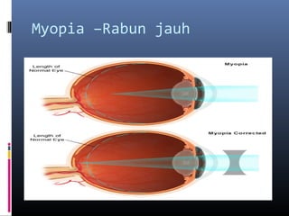 Myopia –Rabun jauh
 