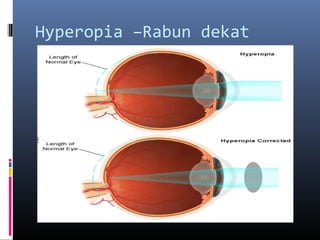 Hyperopia –Rabun dekat
 
