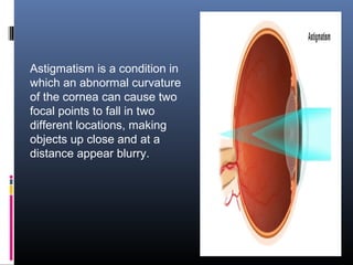 Astigmatism is a condition in
which an abnormal curvature
of the cornea can cause two
focal points to fall in two
different locations, making
objects up close and at a
distance appear blurry.
 