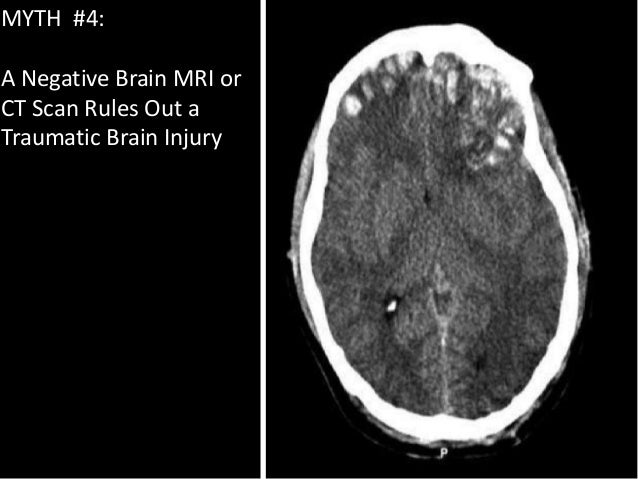 10 common myths and misconceptions about traumatic brain ...