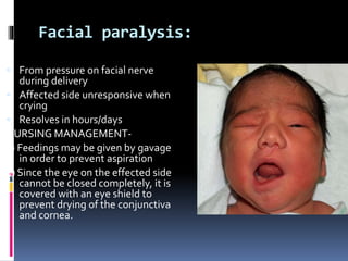Facial paralysis:
 From pressure on facial nerve
during delivery
 Affected side unresponsive when
crying
 Resolves in hours/days
NURSING MANAGEMENT-
a) Feedings may be given by gavage
in order to prevent aspiration
b) Since the eye on the effected side
cannot be closed completely, it is
covered with an eye shield to
prevent drying of the conjunctiva
and cornea.
 