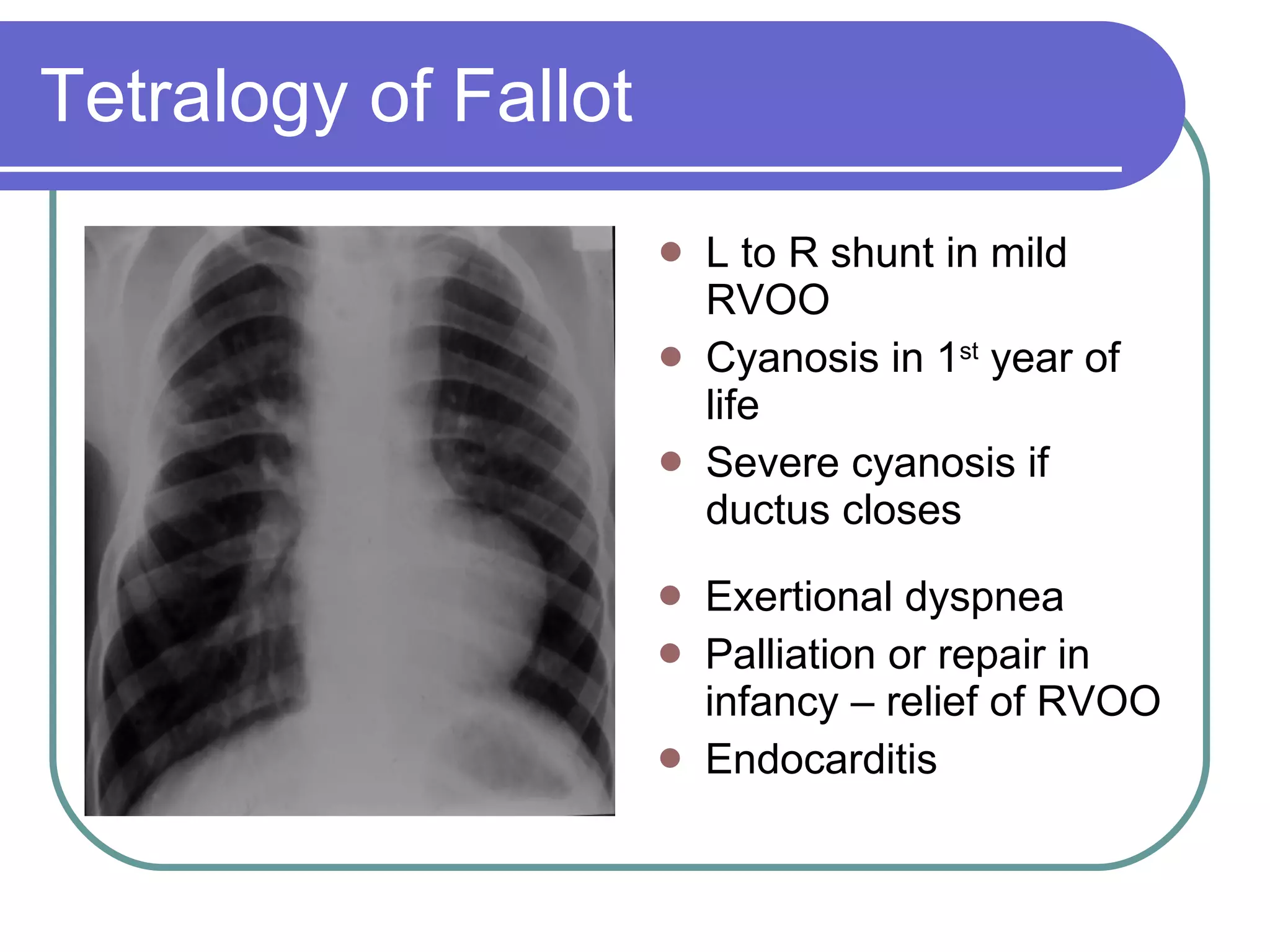 Tetralogy of Fallot L to R shunt in mild RVOO Cyanosis in 1 st  year of life Severe cyanosis if ductus closes Exertional dyspnea Palliation or repair in infancy – relief of RVOO Endocarditis 