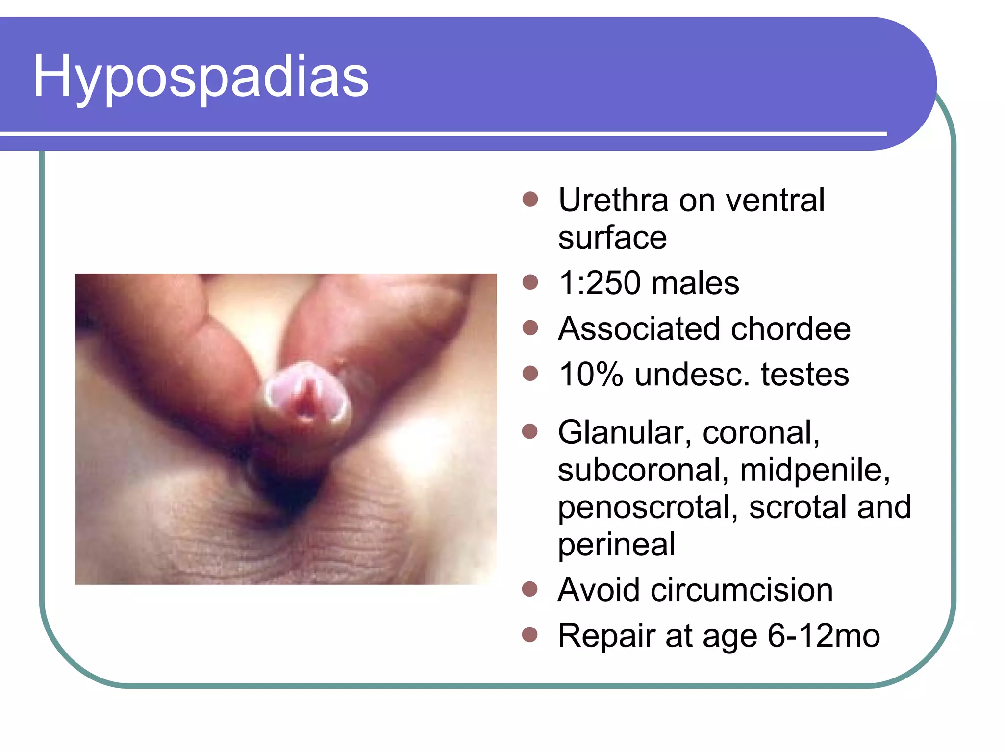 Hypospadias Urethra on ventral surface 1:250 males Associated chordee 10% undesc. testes Glanular, coronal, subcoronal, midpenile, penoscrotal, scrotal and perineal Avoid circumcision Repair at age 6-12mo 