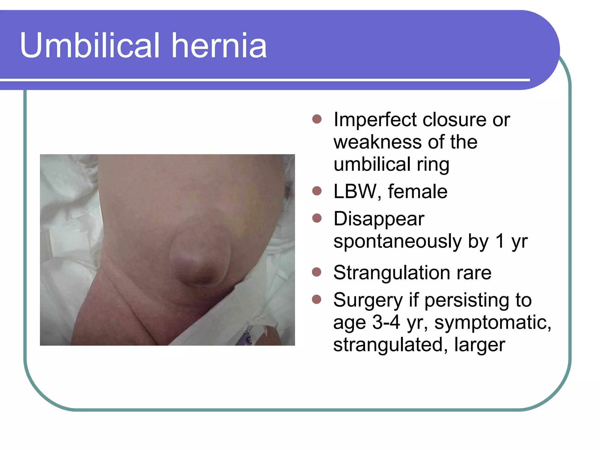 Umbilical hernia Imperfect closure or weakness of the umbilical ring LBW, female Disappear spontaneously by 1 yr Strangulation rare Surgery if persisting to age 3-4 yr, symptomatic, strangulated, larger 