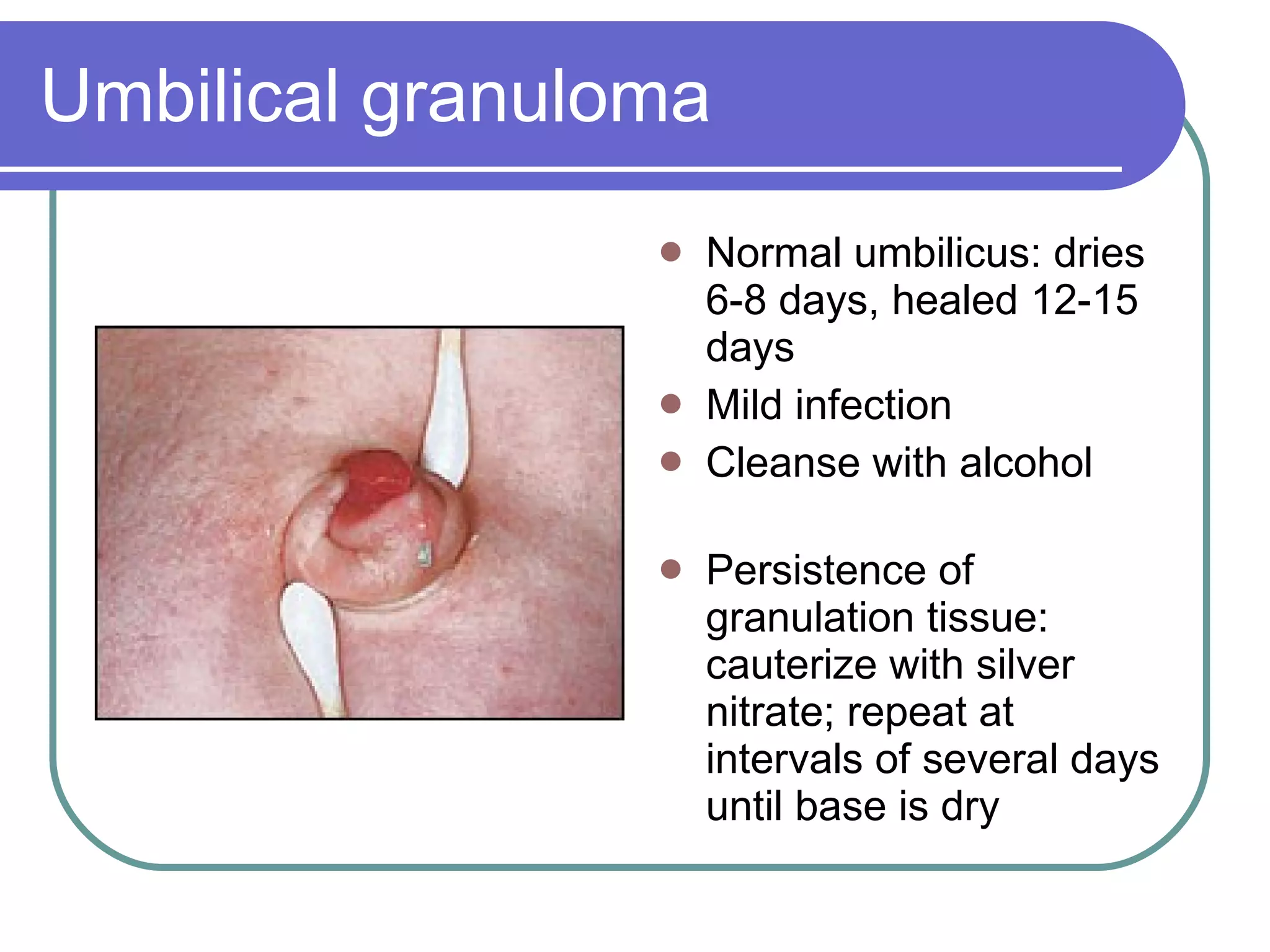Umbilical granuloma Normal umbilicus: dries 6-8 days, healed 12-15 days Mild infection Cleanse with alcohol Persistence of granulation tissue: cauterize with silver nitrate; repeat at intervals of several days until base is dry 