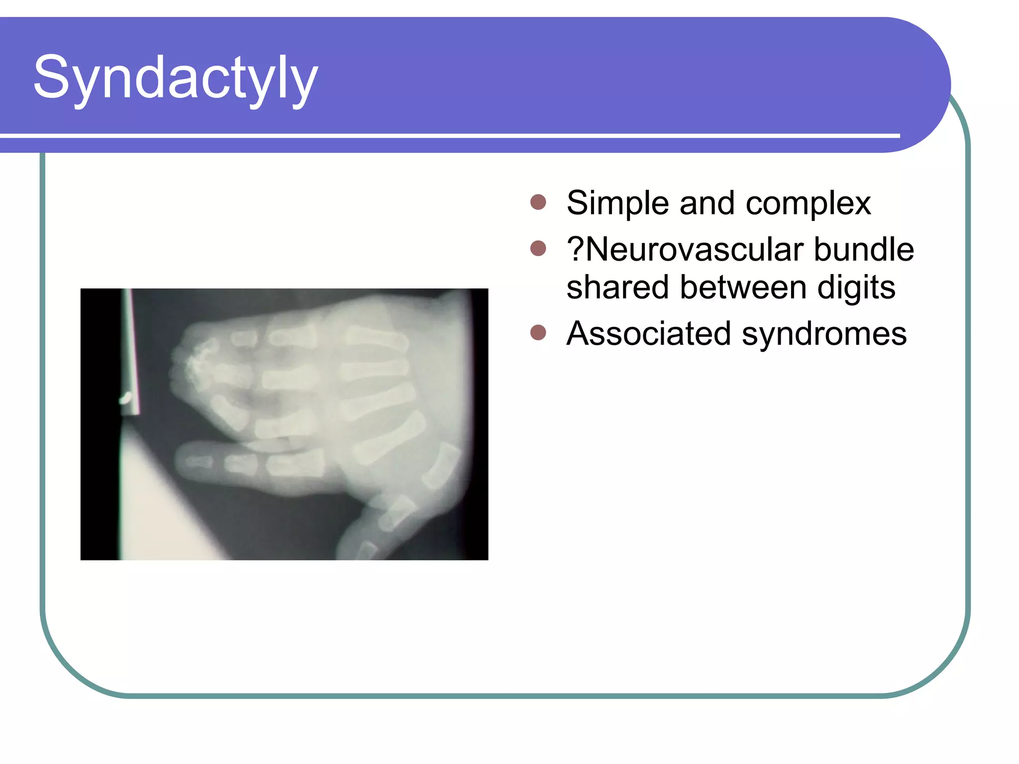 Syndactyly Simple and complex ?Neurovascular bundle shared between digits Associated syndromes 