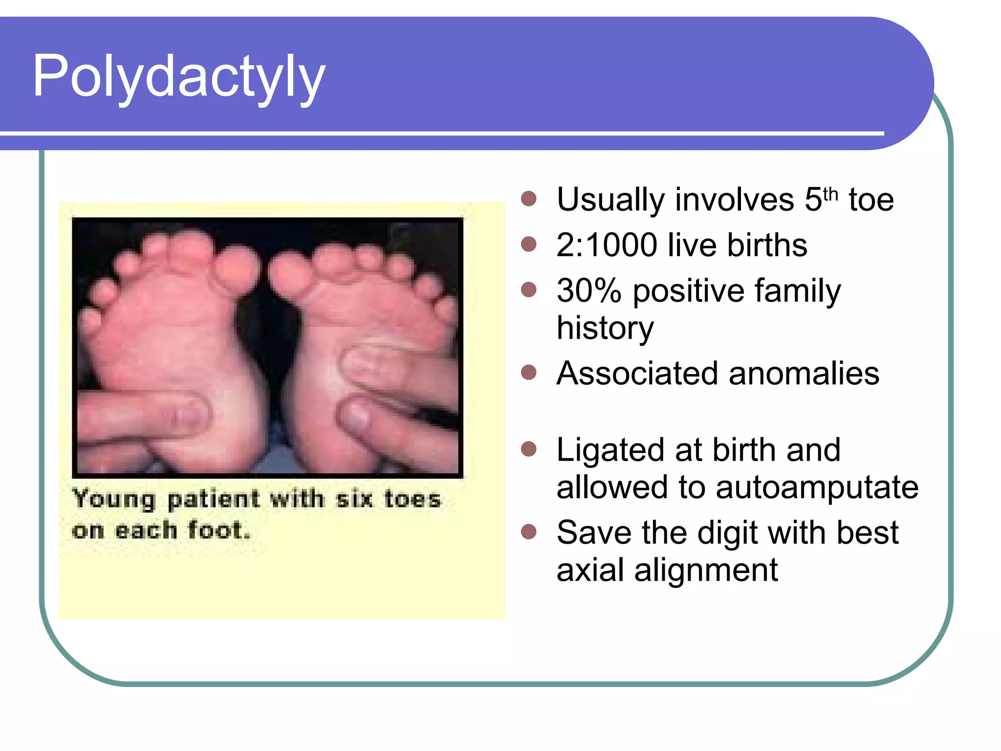 Polydactyly Usually involves 5 th  toe 2:1000 live births 30% positive family history Associated anomalies Ligated at birth and allowed to autoamputate Save the digit with best axial alignment 