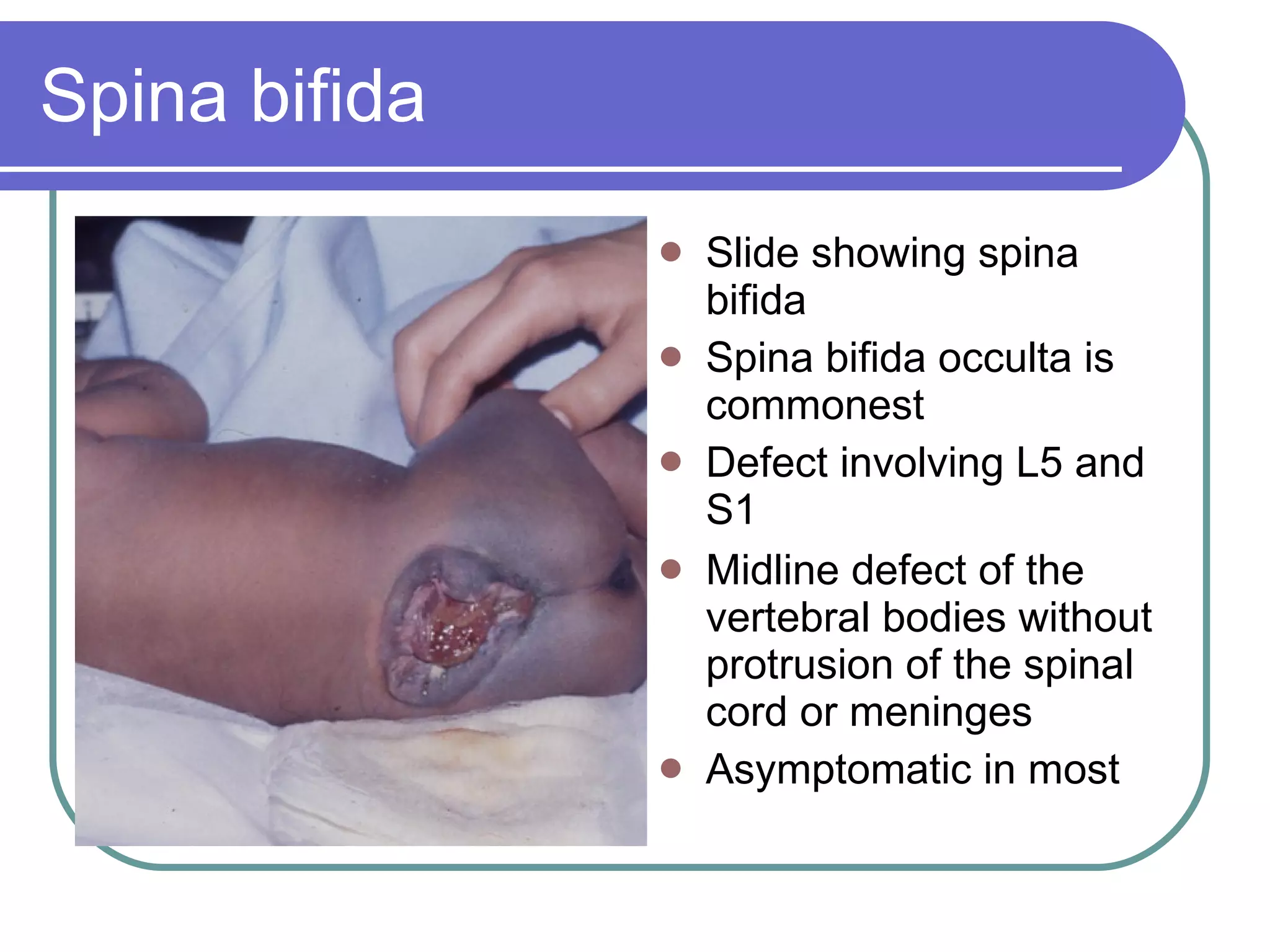Spina bifida Slide showing spina bifida Spina bifida occulta is commonest Defect involving L5 and S1 Midline defect of the vertebral bodies without protrusion of the spinal cord or meninges Asymptomatic in most 