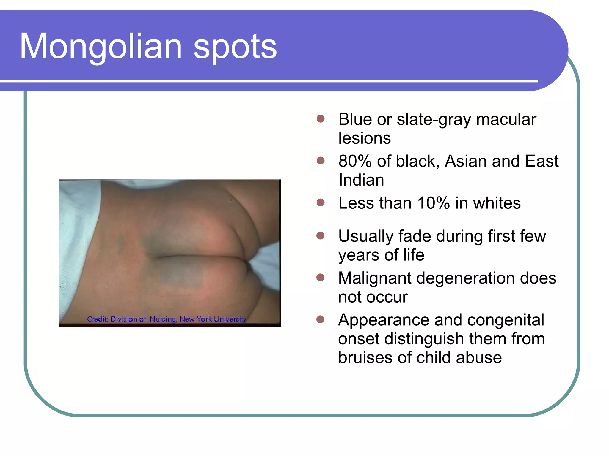 Mongolian spots Blue or slate-gray macular lesions 80% of black, Asian and East Indian Less than 10% in whites Usually fade during first few years of life Malignant degeneration does not occur Appearance and congenital onset distinguish them from bruises of child abuse 