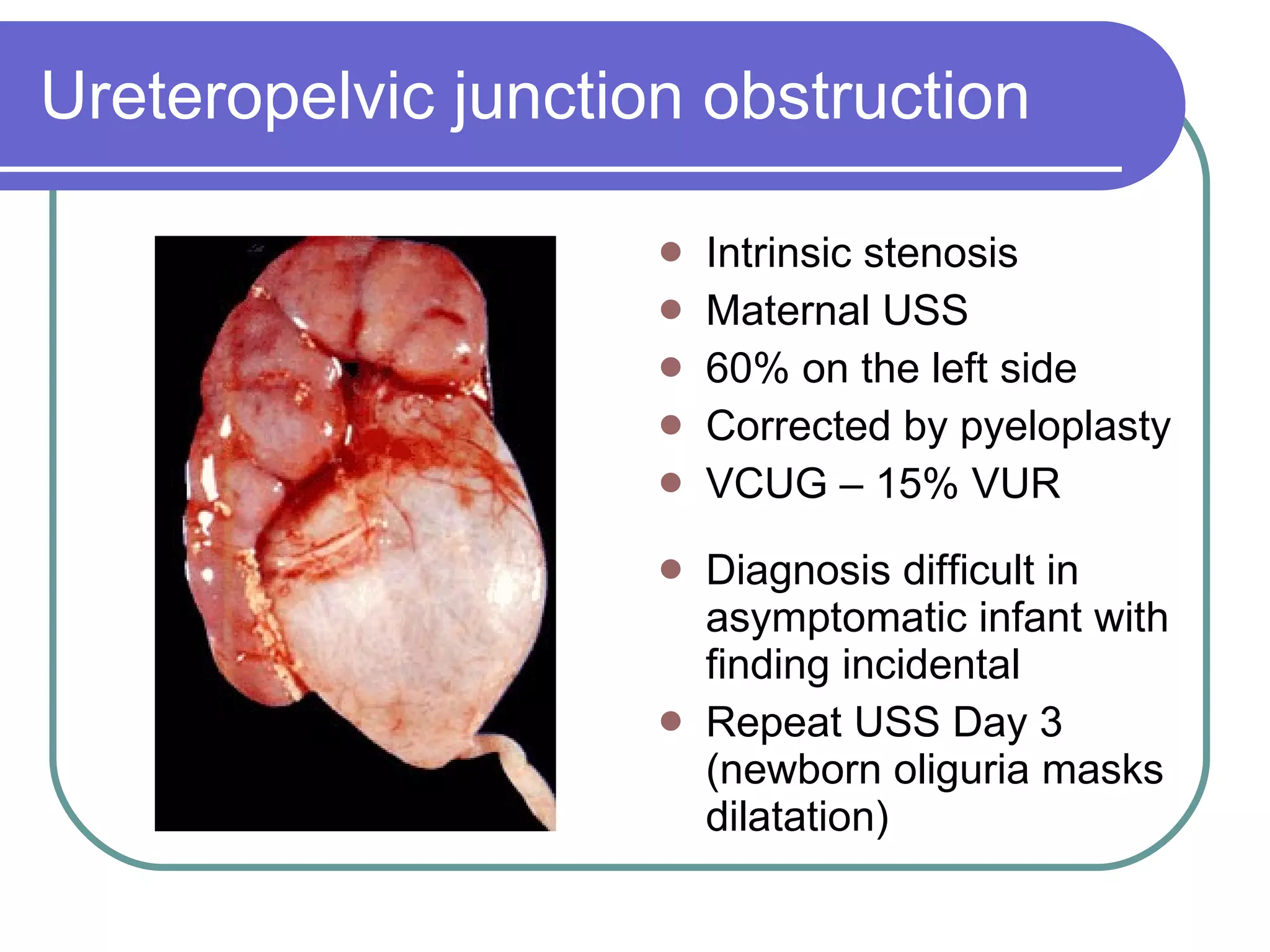 Ureteropelvic junction obstruction Intrinsic stenosis Maternal USS 60% on the left side Corrected by pyeloplasty VCUG – 15% VUR   Diagnosis difficult in asymptomatic infant with finding incidental Repeat USS Day 3 (newborn oliguria masks dilatation) 