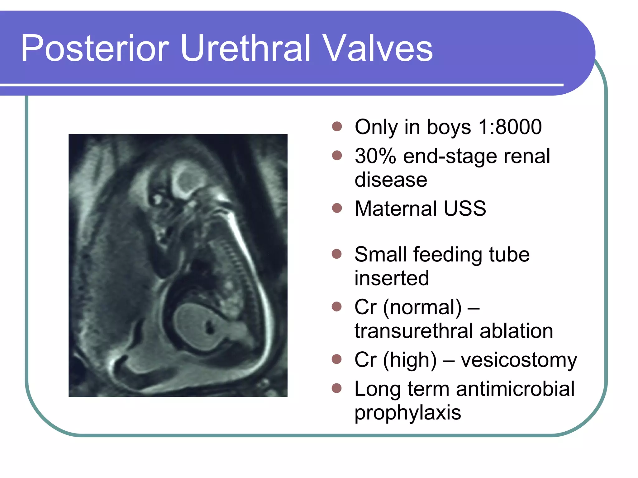 Posterior Urethral Valves Only in boys 1:8000 30% end-stage renal disease Maternal USS Small feeding tube inserted Cr (normal) – transurethral ablation Cr (high) – vesicostomy Long term antimicrobial prophylaxis 