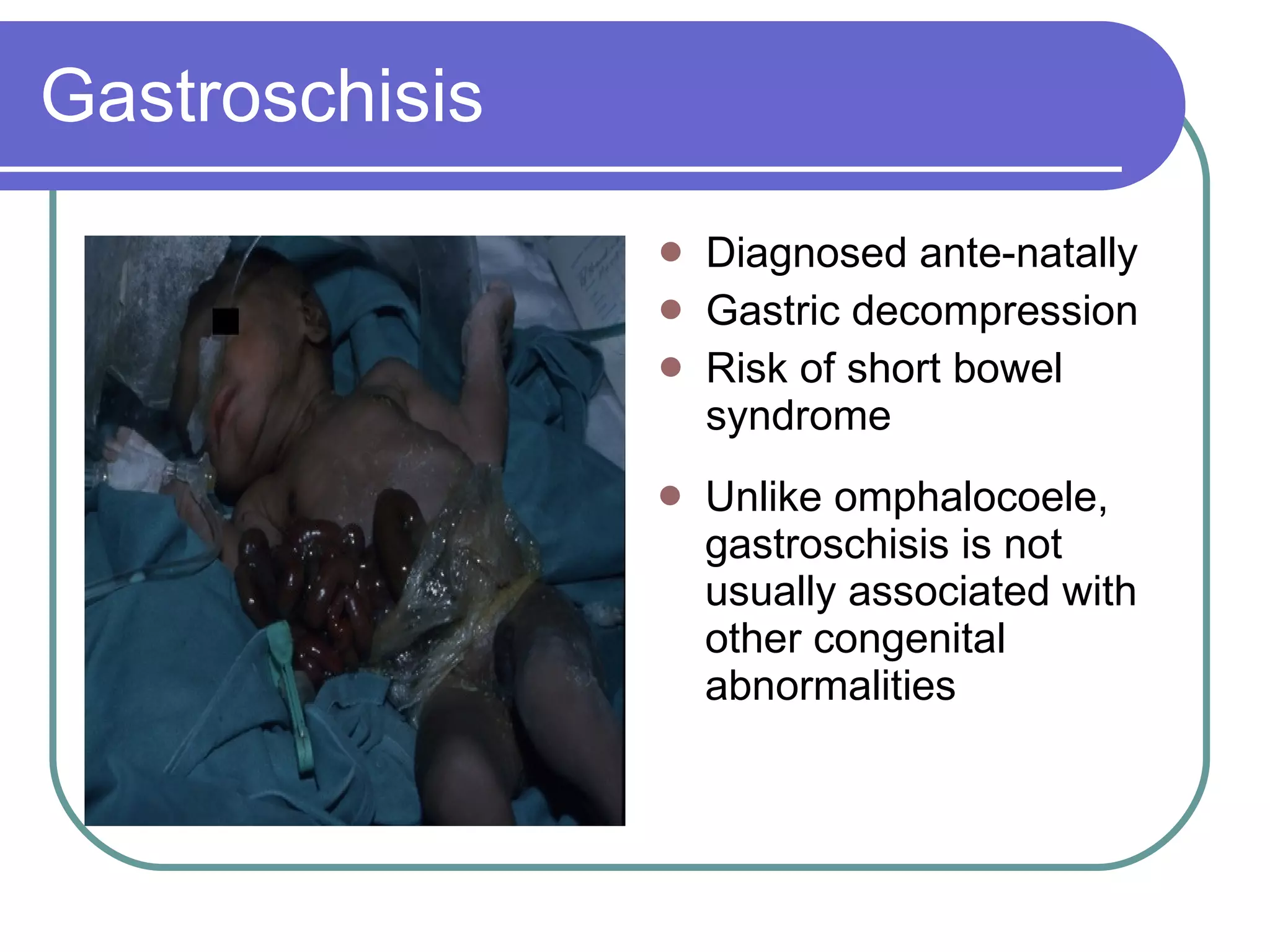 Gastroschisis Diagnosed ante-natally  Gastric decompression Risk of short bowel syndrome  Unlike omphalocoele, gastroschisis is not usually associated with other congenital abnormalities  