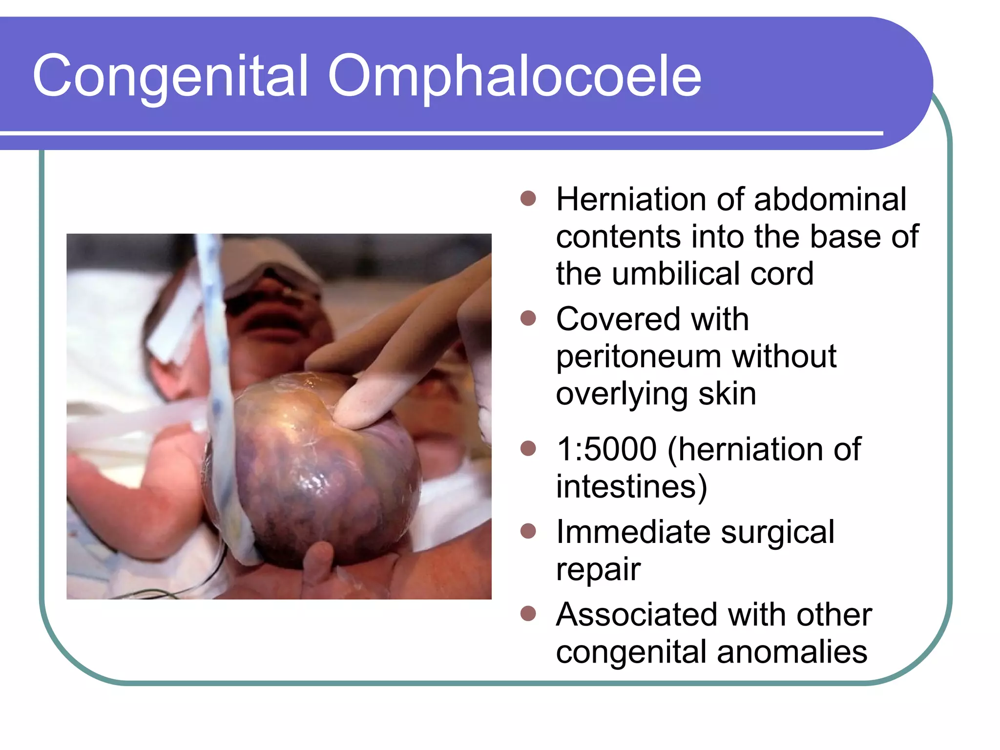 Congenital Omphalocoele Herniation of abdominal contents into the base of the umbilical cord Covered with peritoneum without overlying skin 1:5000 (herniation of intestines) Immediate surgical repair Associated with other congenital anomalies  
