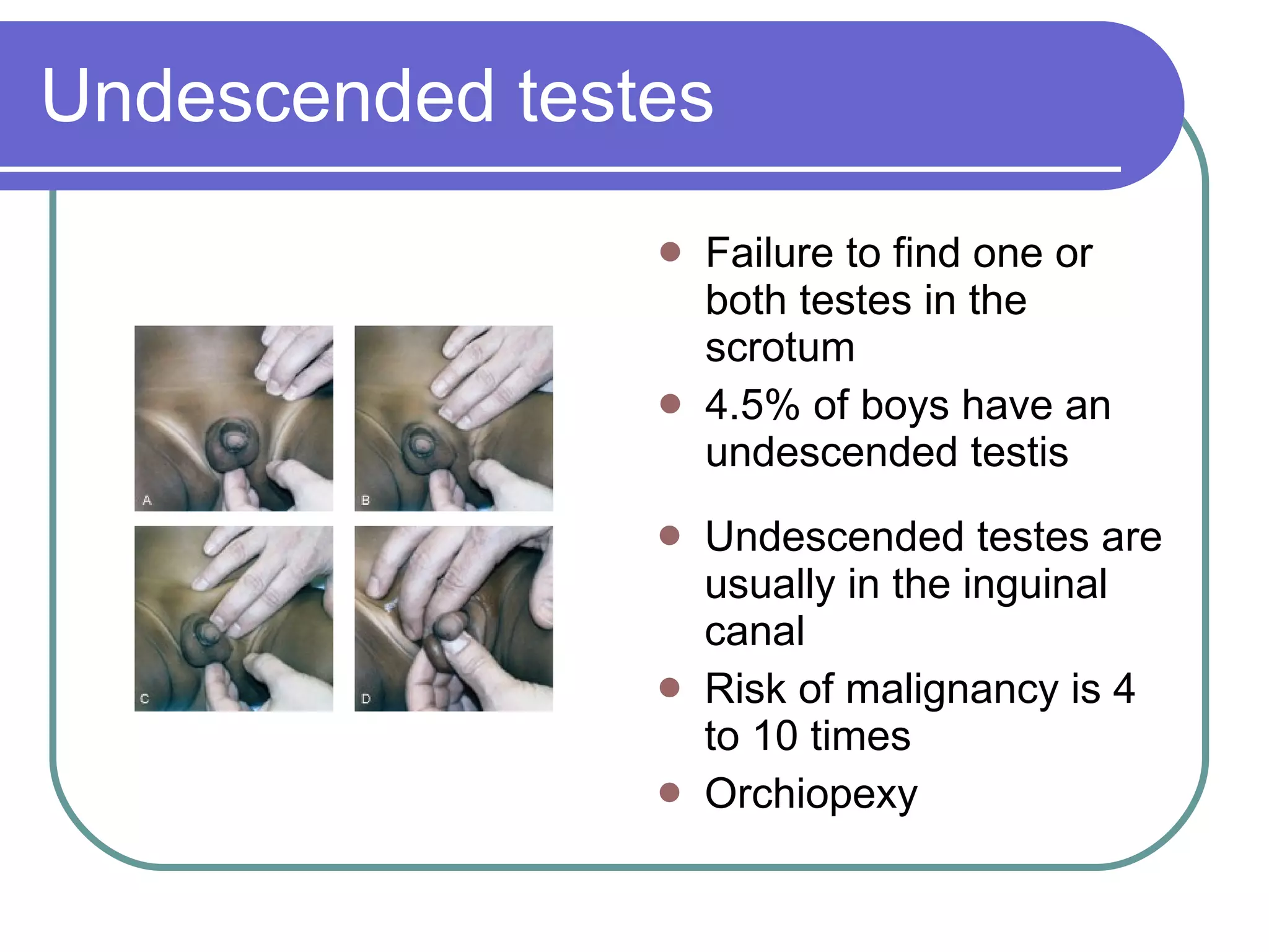 Undescended testes Failure to find one or both testes in the scrotum  4.5% of boys have an undescended testis  Undescended testes are usually in the inguinal canal Risk of malignancy is 4 to 10 times Orchiopexy 