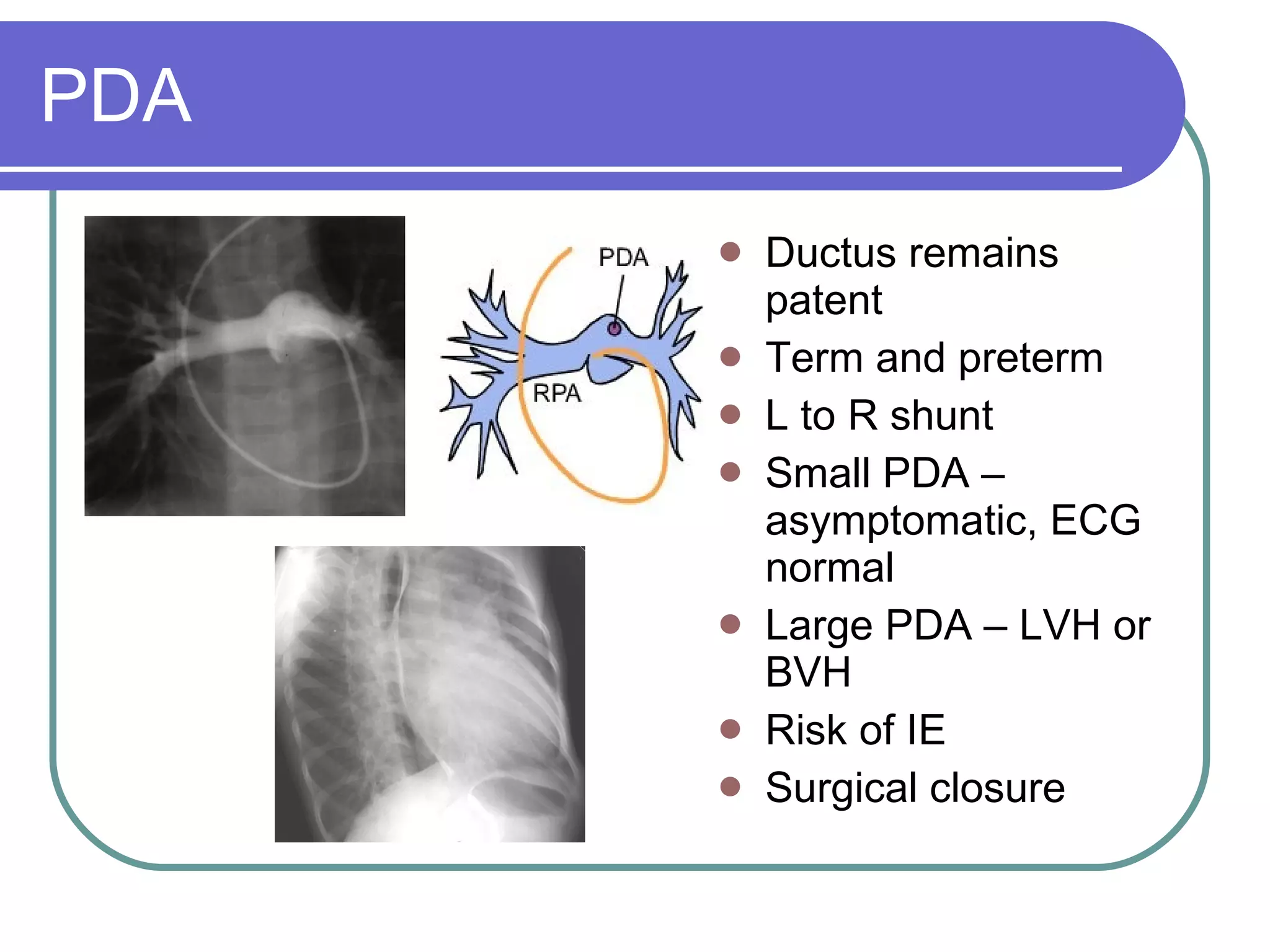 PDA Ductus remains patent  Term and preterm L to R shunt Small PDA – asymptomatic, ECG normal Large PDA – LVH or BVH Risk of IE Surgical closure 