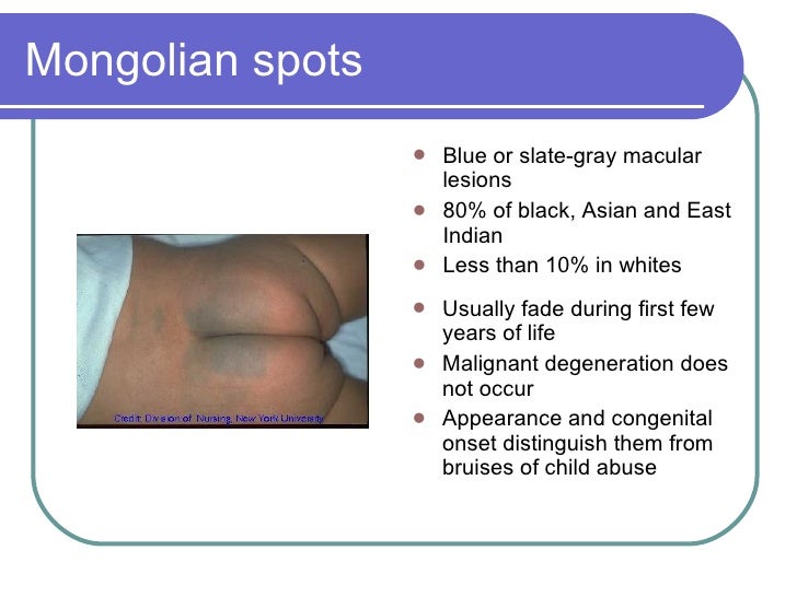 Mongolian Blue Spot Causes Mongolian Spot EHNCA Mongolian Blue Spot Causes Mongolian Spot EHNCA