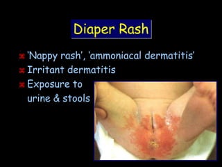 Coliform Nappy Rash Common neonatal problems | PPT