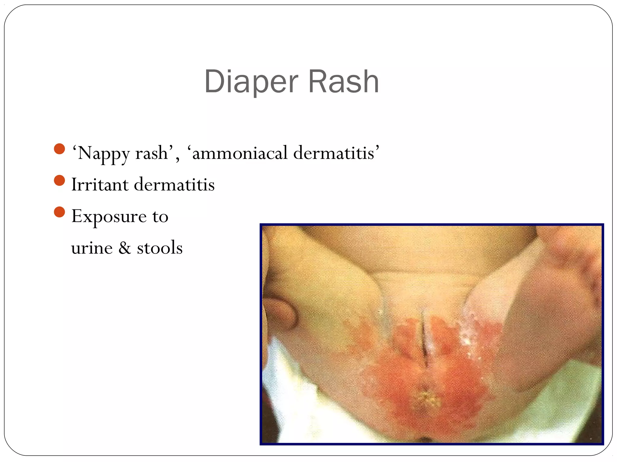 Nuppy Rash Ammonia Dermatitis Diaper Rash