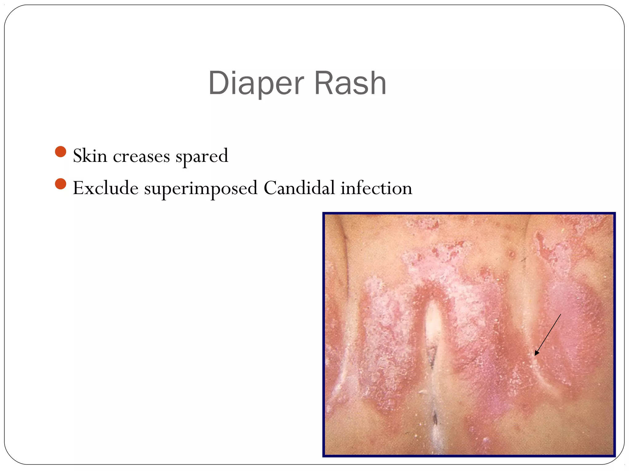 Common neonatal skin problems | PPT