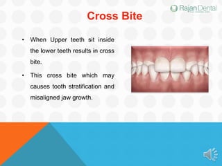 Cross Bite
• When Upper teeth sit inside
the lower teeth results in cross
bite.
• This cross bite which may
causes tooth stratification and
misaligned jaw growth.
 