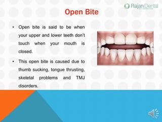 Open Bite
• Open bite is said to be when
your upper and lower teeth don’t
touch when your mouth is
closed.
• This open bite is caused due to
thumb sucking, tongue thrusting,
skeletal problems and TMJ
disorders.
 