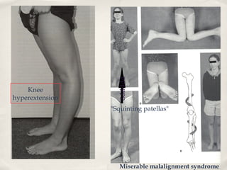Sddddd
    Knee
hyperextension
                 "Squinting patellas"




                    Miserable malalignment syndrome
 
