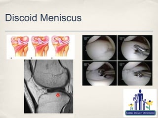 Discoid Meniscus
 