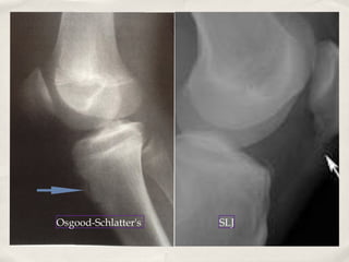 Osgood-Schlatter's   SLJ
 